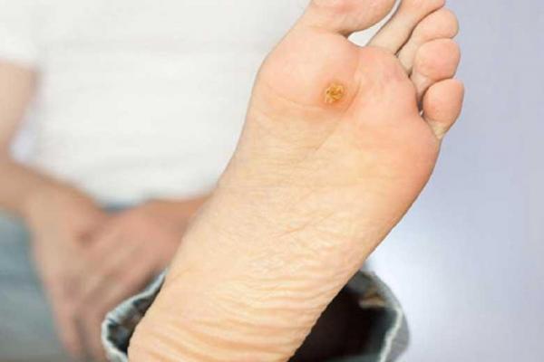 مراقبت های مهم برای جلوگیری از زخم پای دیابتی